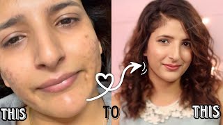 How to get rid of acne scars and acne acnetreatment pimple homeskincare [upl. by Evyn]