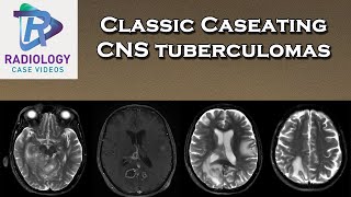 Classic Caseating CNS tuberculomas [upl. by Aknahs]