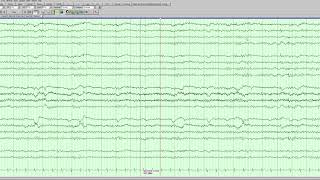 Left parasagittal epileptiform activity [upl. by Aylward]