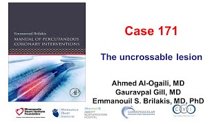 Case 171 Manual of PCI  The uncrossable lesion [upl. by Cia685]