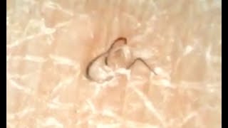 Precise Ingrown Hair Extraction 埋没毛 [upl. by Kirven93]