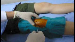 Knee aspiration technique Knee synovitis เจาะเข่า เข่าอักเสบ [upl. by Goldstein819]