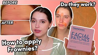 I Tried Frownies Wrinkle Patches For One Week Before and After Testing TikTok [upl. by Ardnosac]