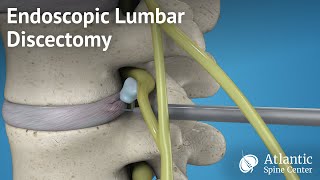 Endoscopic Lumbar Discectomy [upl. by Clayson]