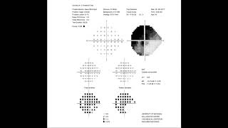 RS Visual Fields Part 2 Interpreting The Test Results [upl. by Ahsitan]