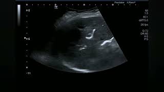 Ultrasound video showing Post ERCP pneumobilia and biliary abscesses [upl. by Dace]