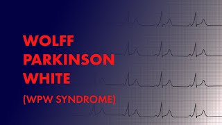 Wolff Parkinson White WPW Syndrome  EKG ECG Interpretation [upl. by Rimaj]