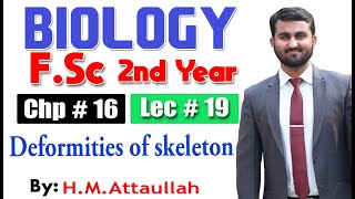 Deformities of skeleton  Chapter 16  2nd year Biology  Lec  19 [upl. by Burhans954]