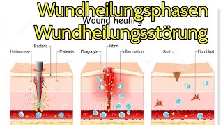 Wundheilungsphasen und wundheilungsstörung im Überblick [upl. by Neelrad26]