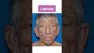 Leprosy  कुष्ट रोग का पूरा इलाज़ संभव है  यह परेशानी आपके हाथों को पूरा ख़राब कर देता है  leprosy [upl. by Eldreda]