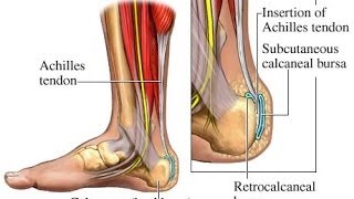 Plantar Fasciitis  Achilles Tendonitis Explained by a Top Pain Physician in Las Vegas Nevada [upl. by Solhcin279]