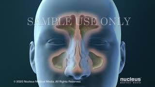 Sinusitis Surgery [upl. by Flanigan]