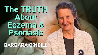 Barbara ONeill reveals the TRUTH about Eczema amp Psoriasis barbaraoneill [upl. by Lupe334]