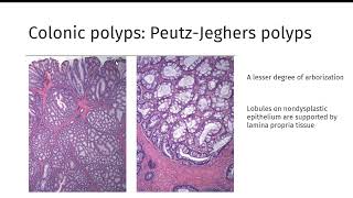 GI polyps GIPATH [upl. by Evanne859]