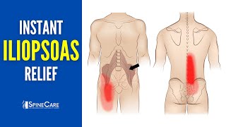 How to Instantly Relieve Iliopsoas Muscle Tightness AND PAIN [upl. by Erma62]