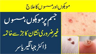 Mokay ka ilaj  Masson ka Ilaj  Warts Treatment  Dr jahangir Yasir [upl. by Christyna]