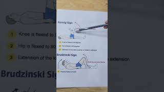 Kernig sign And Brudzenski sign  Acute Meningitis [upl. by Disharoon]