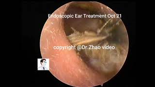 Reexamination of cholesteatoma [upl. by Leinehtan]