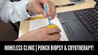 HOMELESS CLINIC PUNCH BIOPSY amp CRYOTHERAPY  S2 Recap Pt 1 [upl. by Cherida]