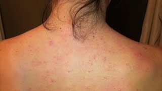 Dayna’s Story Improvement with Folliculitis or “Back Acne” [upl. by Soinski]