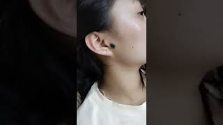 Mole Removed Unwanted Face Mole Remove shorts youtubeshorts trending [upl. by Xela566]