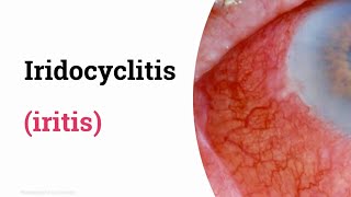 Iridocyclitis iritis [upl. by Itsud]