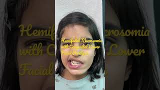 Hemifacial Microsomia with Congenital Lower Facial Paralysis [upl. by Asle]