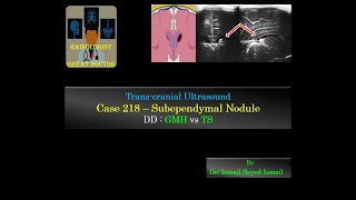 Ultrasound Case 218  Subependymal Nodule  GMH vs TS [upl. by Barbra531]