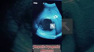 hepatic pyogenic abscess liverabscessliverbiopsy livertumor hepaticencephalopathy hepatologists [upl. by Doownel]