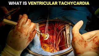 Understanding Ventricular Tachycardia Causes Symptoms and Treatments [upl. by Ducan]