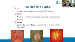 Clinical Grand Rounds in Optic Neuropathies “You’ve Got Some Nerves” [upl. by Elo402]