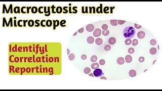 Macrocytosis under microscope  Macrocytosis rbc [upl. by Rusty244]