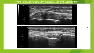 Echographie dune entorse médiale du genou [upl. by Ibocaj]