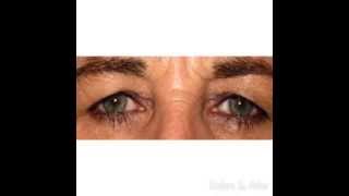 Ptosis Repair with a Levator Advancement in Tampa FL [upl. by Lirrad]