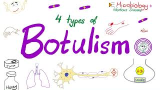 Four Types of Botulism  Foodborne botulism Infant botulism Wound botulism amp Inhalation botulism [upl. by Toile]