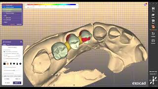 dental coping design exocad [upl. by Froh]