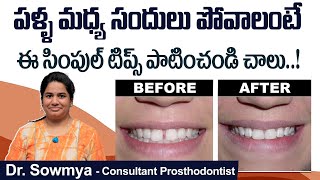 పళ్ళ మధ్య ఖాళీ ఉందా How to Close Gap Between Teeth  Teeth Gap Treatment  Eledent Dental Hospitals [upl. by Aubin857]