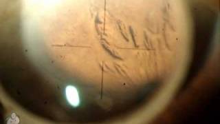 Laser peripheral iridotomy LPI [upl. by Marven]