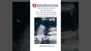 SPLENIC ABSCESS WITH LEFT PLEURAL EFFUSION drrandhawainstitute pocus ultrasound medicalvideos [upl. by Mcquillin]