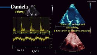 Diastolic dysfunction amp the PW Doppler for assessing volume status with ultrasound 〖Ultrasound〗 💘 💫 [upl. by Ardnahcal521]