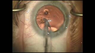 CCS in hingedbased accommodative intraocular lenses  Video S3 [upl. by Keppel]