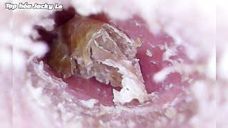 Ear Wax Removal 220 The earwax was so big that it made him itch like crazy  Ear Cleaning ASMR [upl. by Simara]