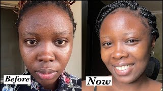 How to achieve Youthful glowing skin  How i cleared tiny bumpsrashes on my face SKINCARE ROUTINE [upl. by Enileuqaj]