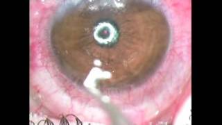 Intracorneal ring implantation  Supplementary video 26118 [upl. by Irak]