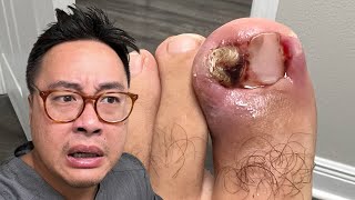 IS THIS THE WORSE INGROWN YOU EVER SEEN [upl. by Valenta]