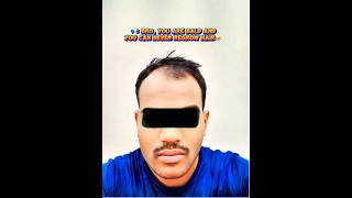 Hair Transplant Results hsn ameerht hairloss hairlosstreatment [upl. by Geldens]