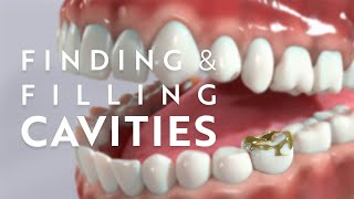 The process of finding and filling dental cavities [upl. by Antonino]