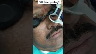 CO2 laser peeling [upl. by Htiek]