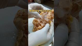 Kidney disease cystic kidney disease சிறுநீரக நோய்  biopsy endometrialpolyp kidneystone [upl. by Dowzall]