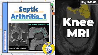 Fig 5E01 Earliest Findings of Septic Arthritis [upl. by Richia48]